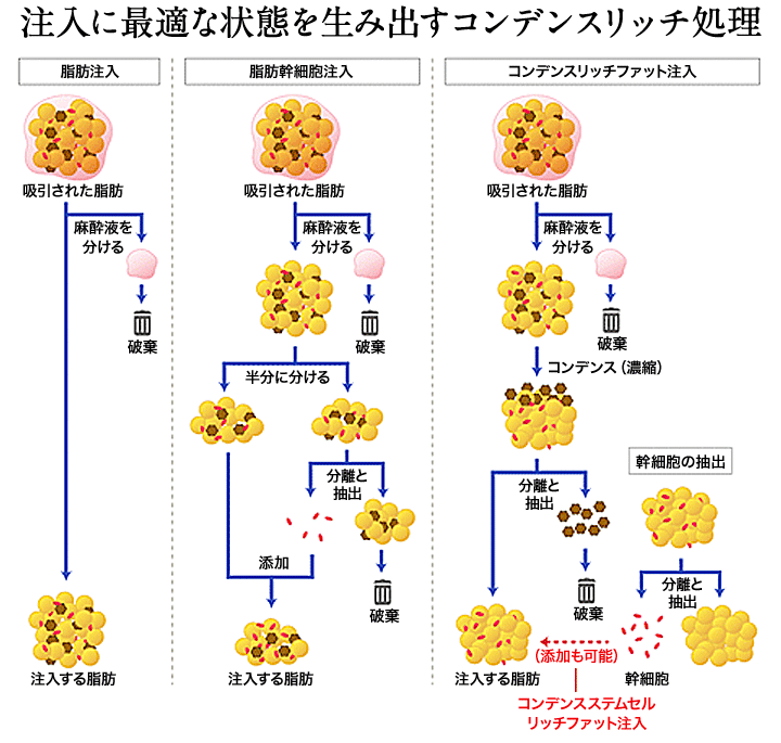 注入に最適な状態を生み出すトリプル・コンデンス処理