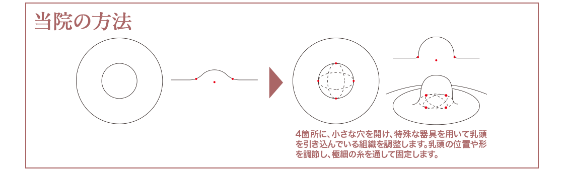 当院の方法