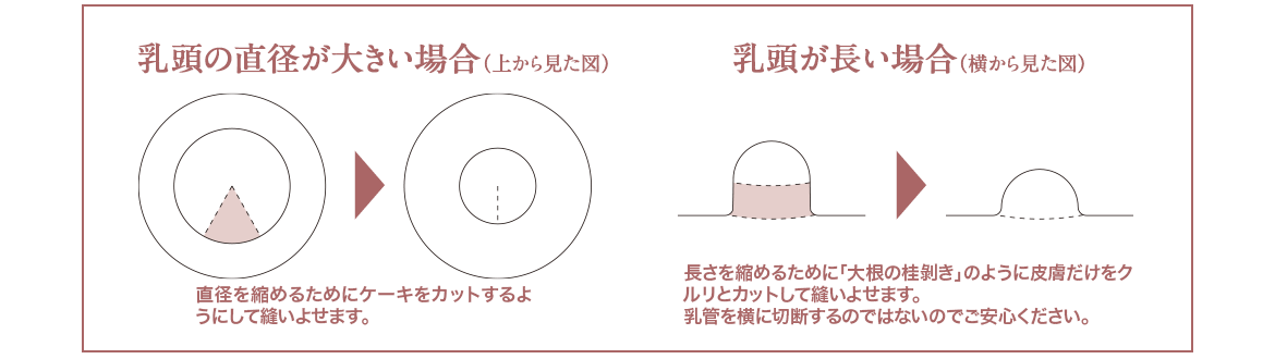 乳頭手術