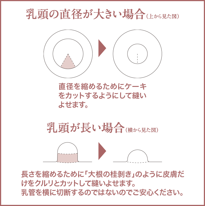 乳頭手術